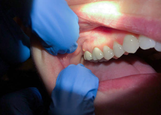 Best Emergency Treatment for Dental Infections or Abscesses in Pennsburg, PA